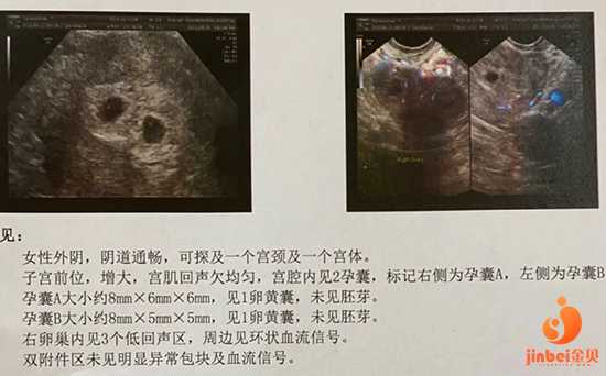 香港验血吃过保胎药还准吗,试管婴儿移植单胎变双胎